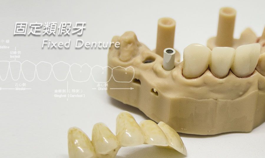 固定類假牙